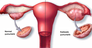 polikistik over sendromu